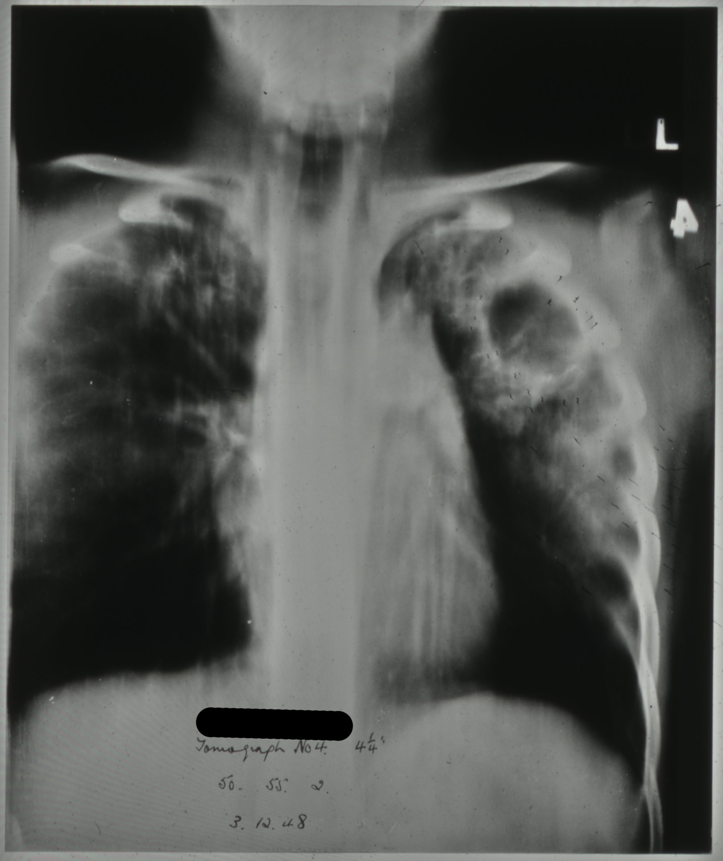 case study of pulmonary tuberculosis